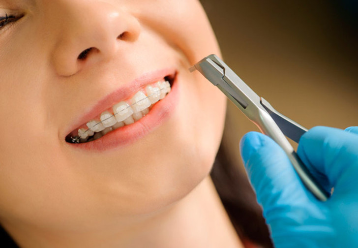 Сапфировые брекеты Сапфировые брекеты