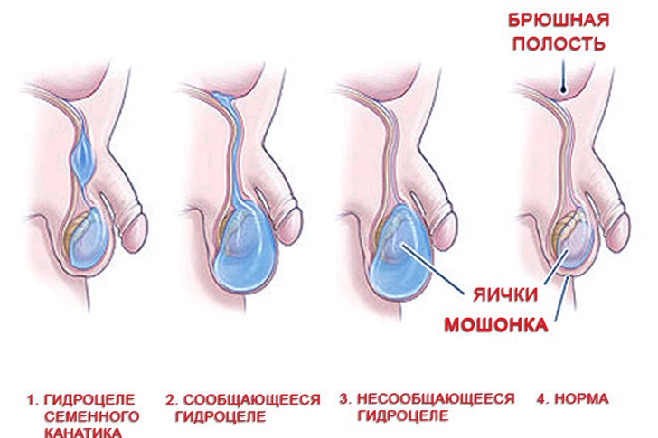 vodyanka_yaichka_u_rebenka_593_262_cr